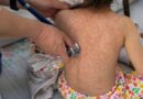 Estrategias para prevenir un brote de sarampión en México ante el repunte en Europa